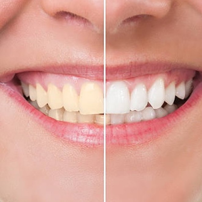 Teeth Whitening in Grande Prairie