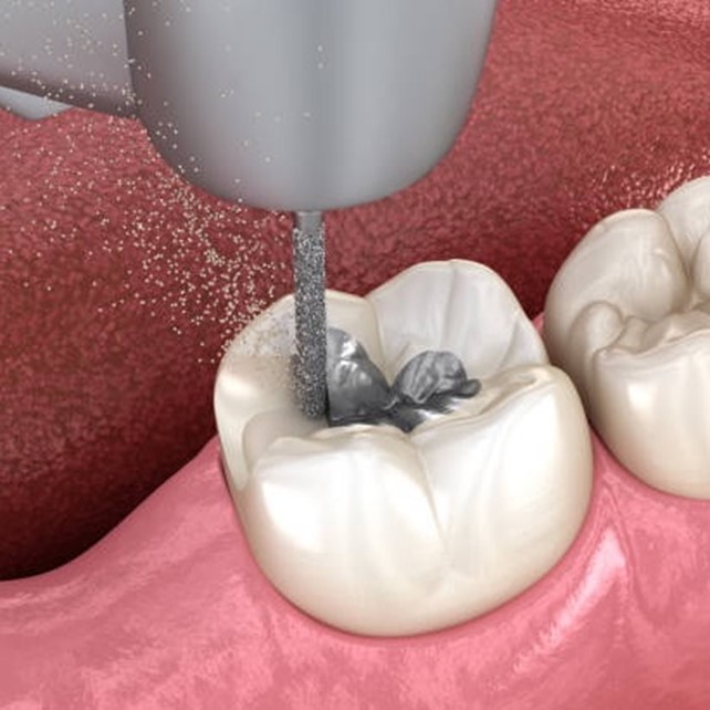 Amalgam Replacement Near You