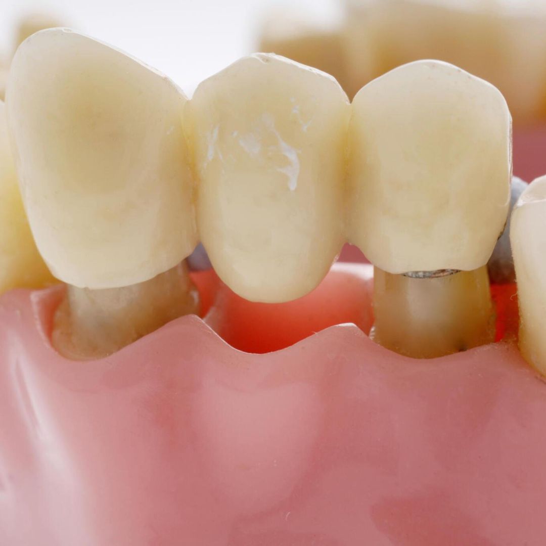 Benefits of Dental Bridges