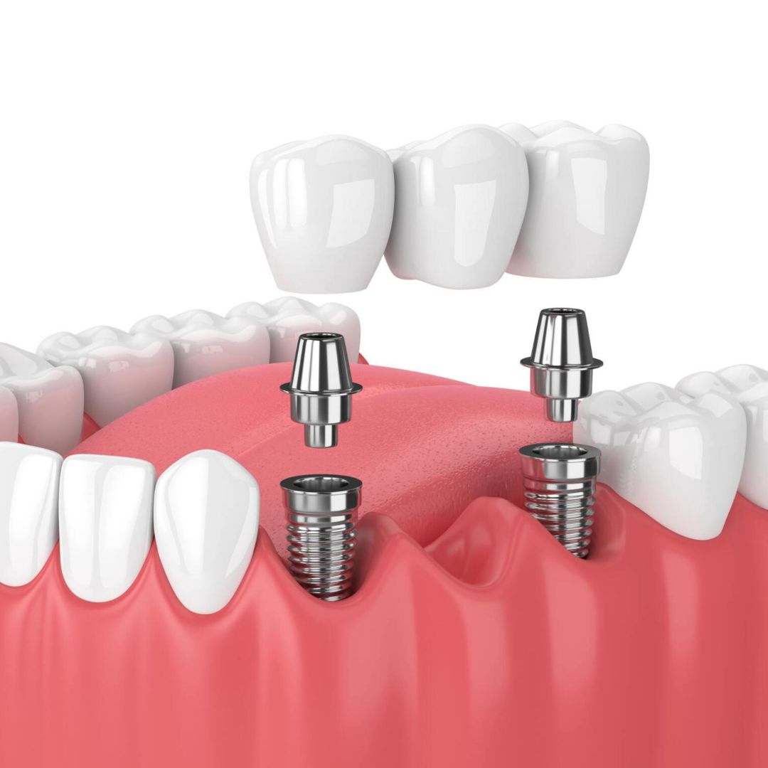 Caring for Your Dental Bridge