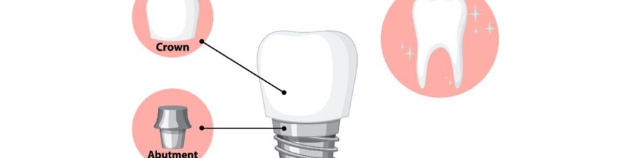 Components of Dental Implants