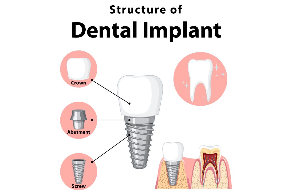 Components of Dental Implants