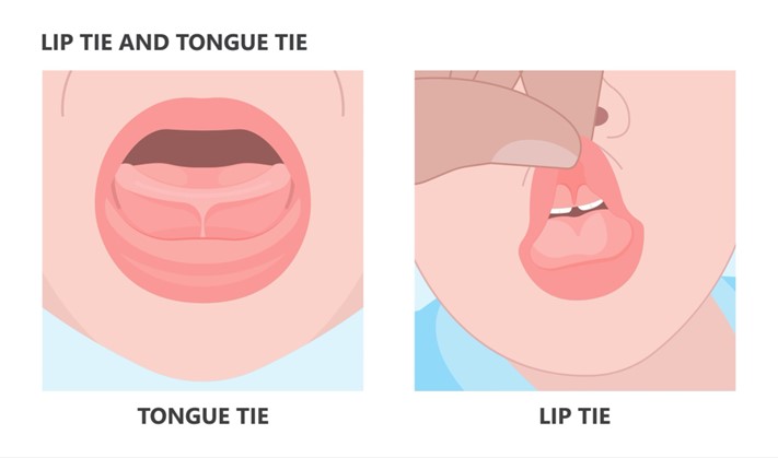 Frenectomy Surgery Near You