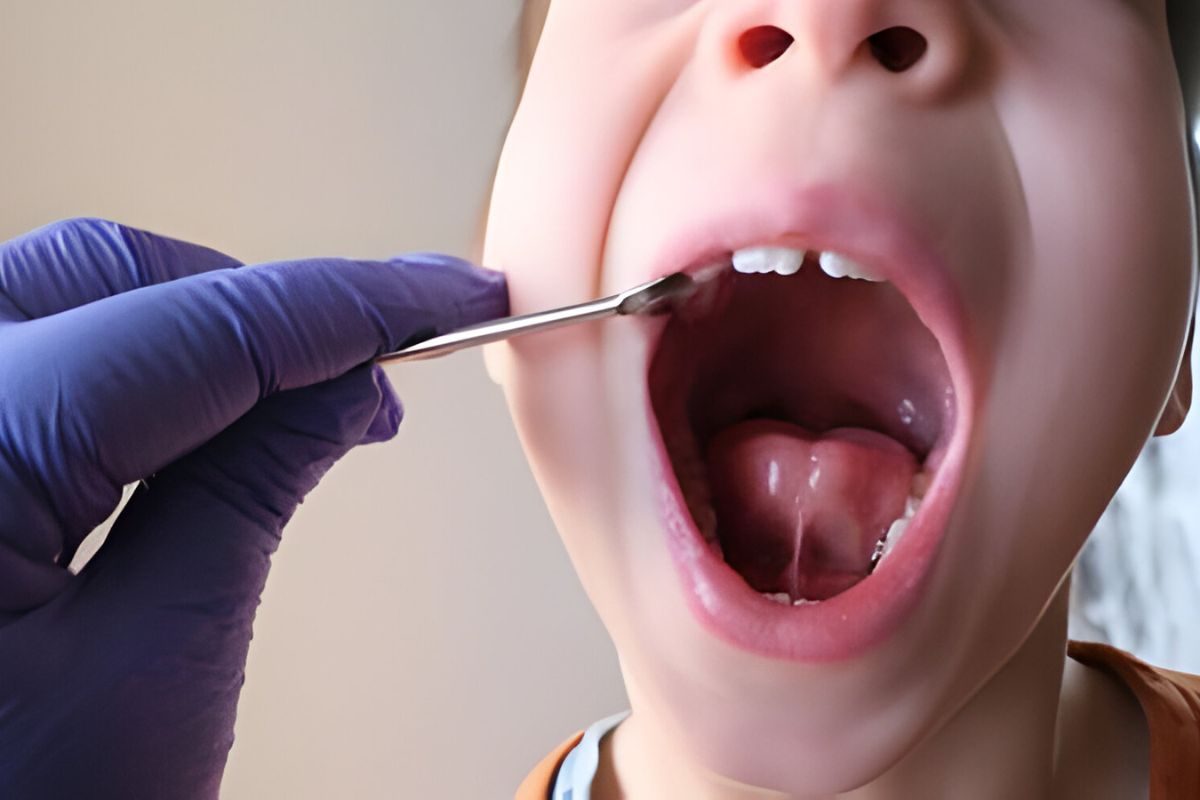 Frequently Asked Questions Answered by Experts About Frenectomy